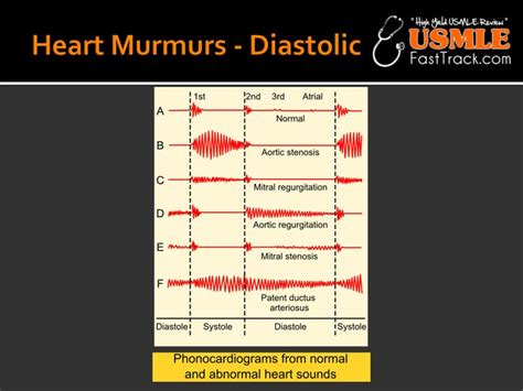 Heart Murmurs Aortic Regurgitation And Mitral Stenosis Usmle First