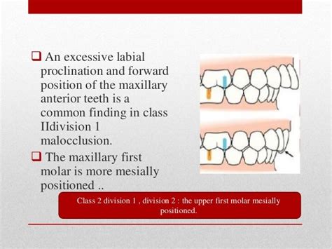 Class Ii Division 1 Malocclusion