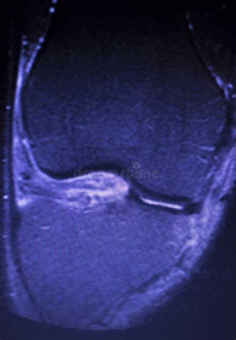 Mri Knee Meniscus Tear Scan Stock Image Image Of Clinic Human 144812131