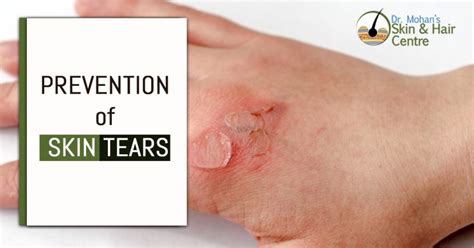 Treatment And Prevention Of Skin Tears