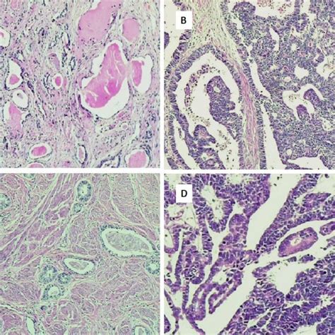 A Uterine Cervix Biopsy Shows Tubular Structures With Luminal