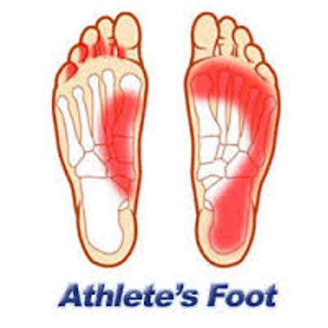 8 Facts About Athletes Foot Fact File