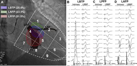 Relationship Of Paced Left Bundle Branch Pacing Morphology With Anatomic Location And