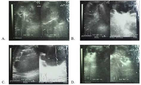 Gambar 1 Usg Abdomen Pada 15 Juli 2015 Di Rs Urip Sumoharjo Bandar