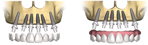 Implantologia Transmucosa O Flapless Impianti Dentali Prezzi