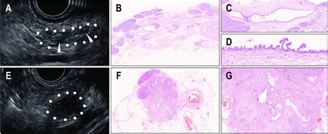 Representative Endoscopic Ultrasound Imaging And Pathological Findings Download Scientific