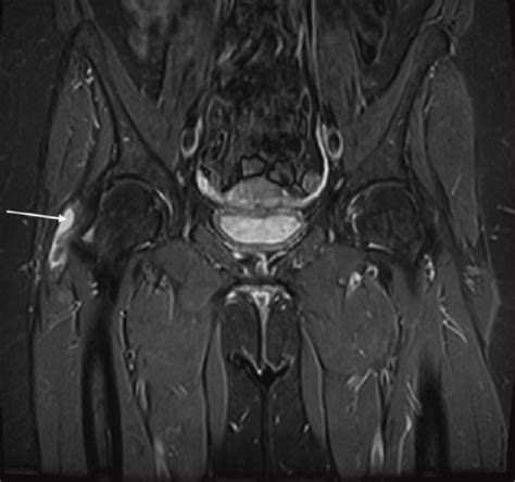 Coronal Magnetic Resonance T Stir Image Of The Right T Open I