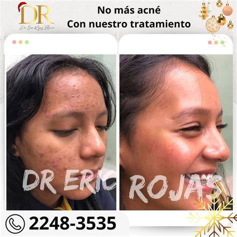 Rejuvenece tu rostro con la nueva técnica Dr Eric Rojas