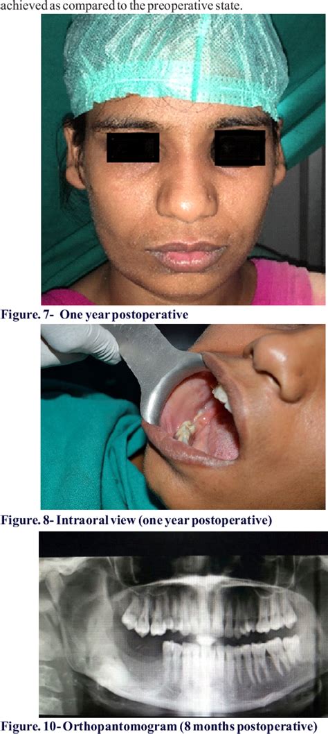 Figure From Conservative Management Of Ameloblastoma In An Adolescent