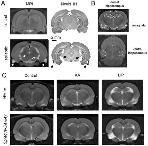 Magnetic Resonant Imaging Mri A T2 Weighted Mri Was Used To Look