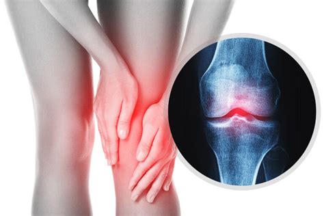 All You Need To Know About Osteoarthritis Boost Physiotherapy