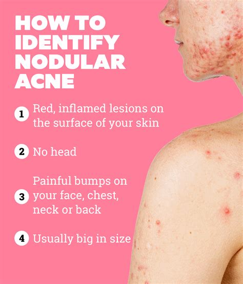 What Is Nodular Acne And How To Treat It