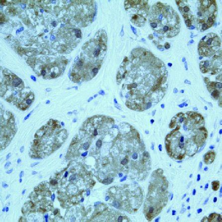 The Tumor Cells Are Large Round Polygonal With Abundant Eosinophilic