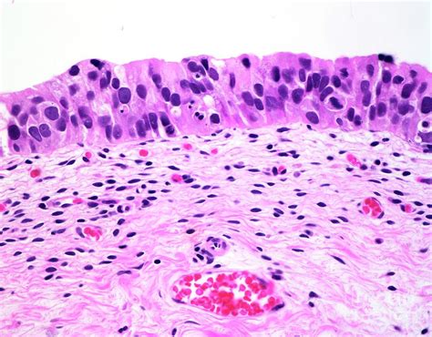 Urothelial Carcinoma In Situ Photograph By Webpathology Science Photo