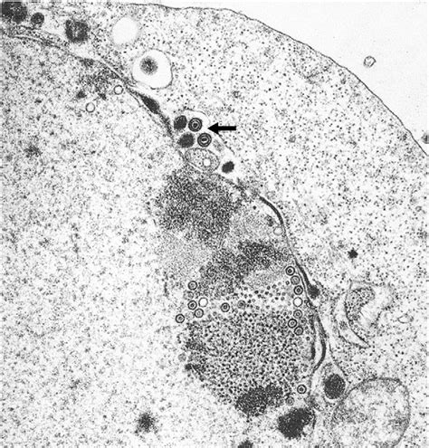 Herpes Simplex Virus Infections The Lancet