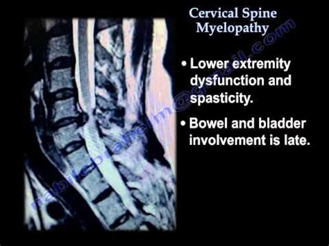 Traumatolog A Y Ortopedia Cirug A De Columna Cervical Spine Myelopathy