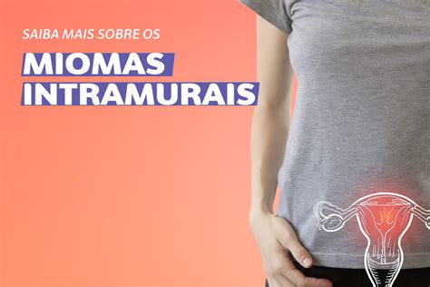 Saiba mais sobre os Miomas Intramurais Clínica Ayroza Ribeiro