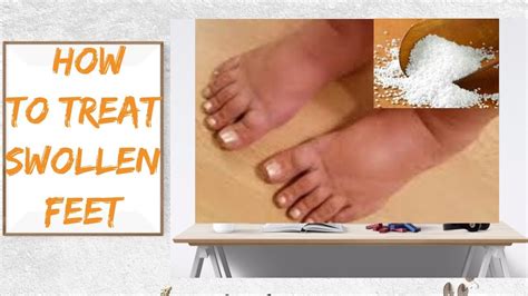 Swollen feet, Effective remedies to treat swollen feet at home. - YouTube