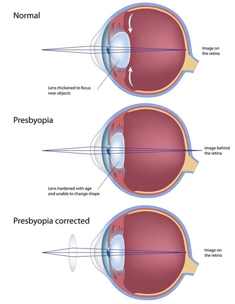 Presbyopia Norfolk Virginia Beach Va