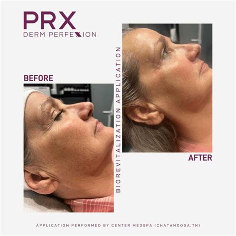 Prx Derm Perfexion Interlocks Medspa