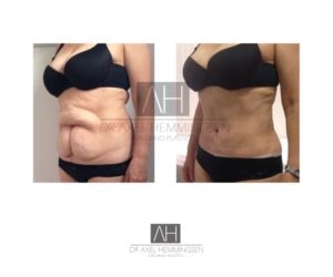 Abdominoplastia Dr Axel Hemmingsen