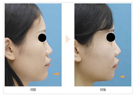 顔が大きく見える原因と小顔になる方法（顔を小さくする整形） 輪郭形成・小顔整形 コラム｜池袋の小顔整形・顔痩せ・輪郭整形（骨切り・脂肪吸引など）｜みずほクリニック