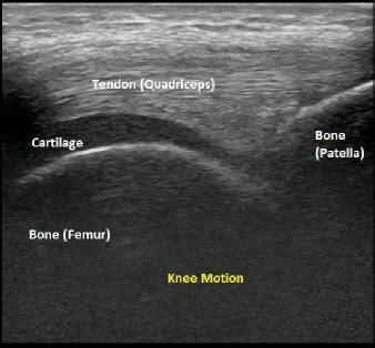 Knee Ultrasound