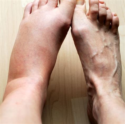 Reasons Why You Have Swollen Feet According To A Doctor Swollen