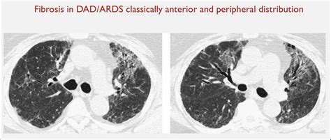 Dr Khaled Ahmed Abuzeid On Twitter Association Of Fibrosis Reticular