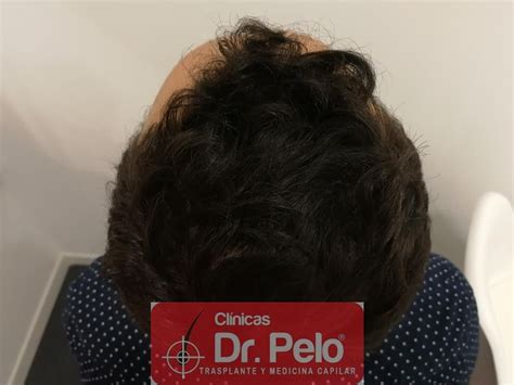 Caso 44 Injerto Capilar Con 1 835 Grafts 3 912 Pelos Dr Junior