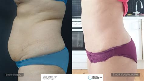 Abdominoplastia Plastic Surgery Before And After Photos