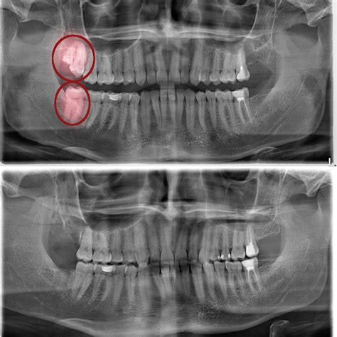 Wisdom Tooth Extraction - Grande Prairie Family Dental