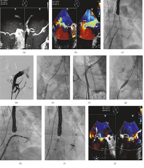 Figure From Sequential Venous Percutaneous Transluminal Angioplasty