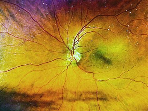 What Are The Different Stages Of Diabetic Retinopathy