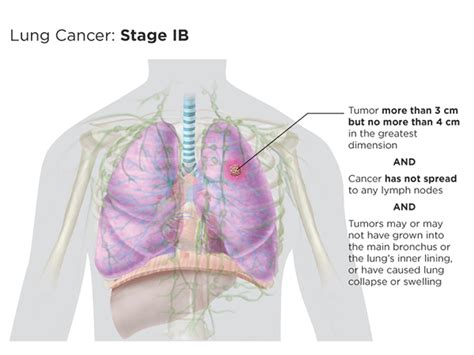 Lung Cancer Staging Lungevity Foundation