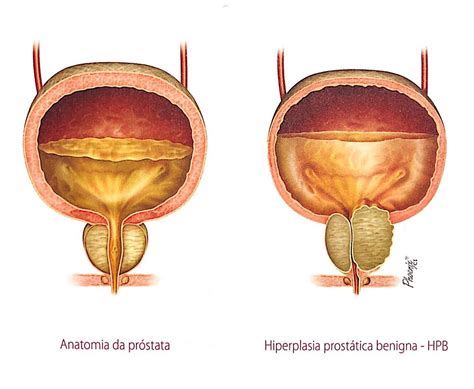 Hiperplasia Prostática Benigna