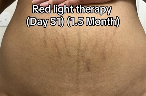 Red Light Therapy Results R Redlighttherapy