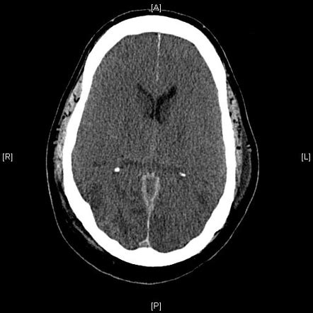 Anoxic Brain Injury Secondary To Cardiac Arrest Image Radiopaedia Org