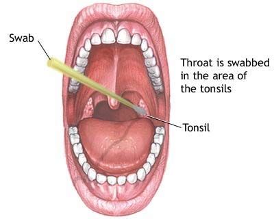 throat cancer info: signs of throat cancer