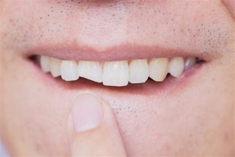 How To Fix A Chipped Tooth