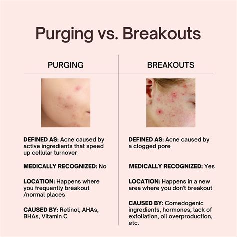 Skin purging vs breakout how to tell the difference – Artofit