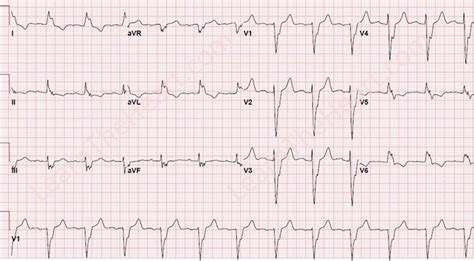 Infarcts And Ischemia Ecg 3 Learn The Heart