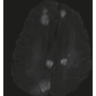 Image Of Mri Brain Showing Multifocal Areas Of Diffusion Restriction