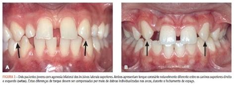 Tratamento De Agenesia De Incisivos Laterais Zachrisson