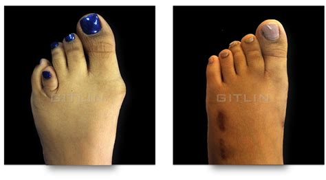 Brachymetatarsia Brachymet Short Toe — Foot Ankle Surgery