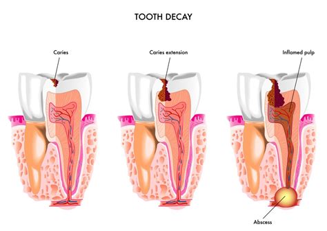 Cellulitis Gulf Coast Endodontics