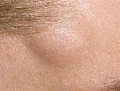 Yağ Bezesi Lipom Nedir Tehlikeli Midir Dermatoloji Uzmanı Dr