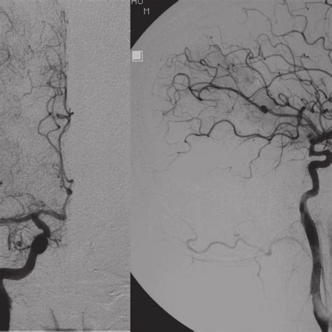 Postoperative Angiography Right Carotid Angiography Showed Almost Download Scientific Diagram