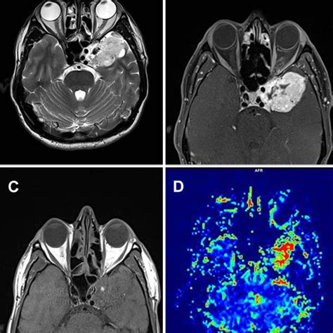 Postoperative Magnetic Resonance Images A Axial T2w Sequences Show