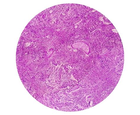 Premium Photo High Grade Transitional Cell Carcinoma Or Tcc A Bladder